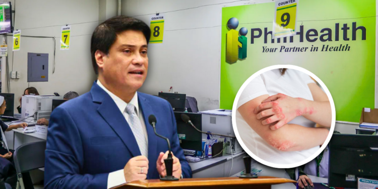 Zubiri calls for PhilHealth to shoulder lupus screening costs after Senate approval