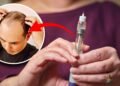 Popular GLP-1 Weight-Loss Drugs Linked to Higher Rates of Hair Loss and Nail Detachment in New Study